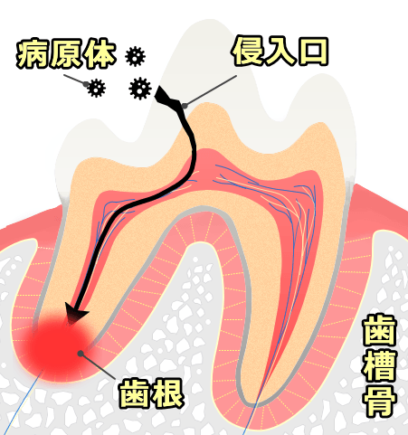 歯根膿瘍の模式図～病原体の侵入口と歯根部における炎症