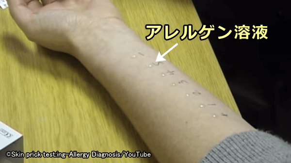 アレルゲン溶液を前腕の内側に