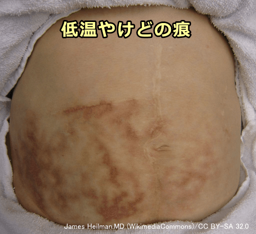 低温でも長時間当て続けると皮膚が変化する