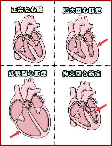 正常な心臓の断面図と拡張型心筋症の模式図
