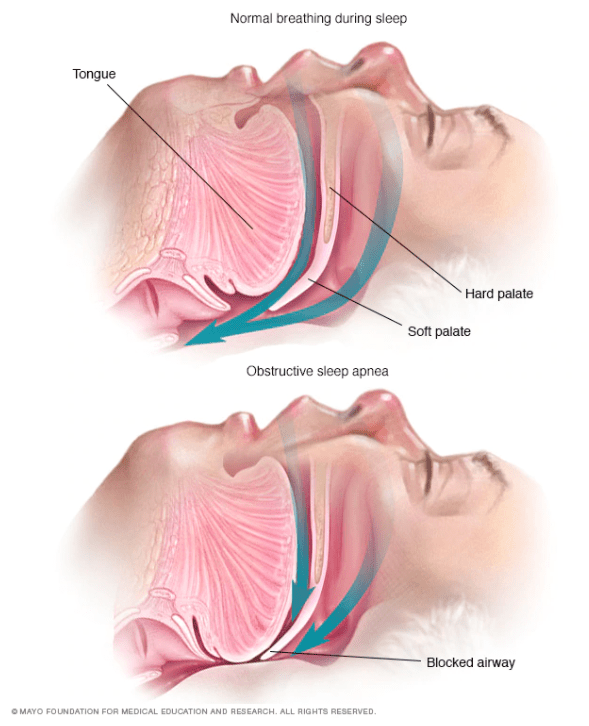 閉塞性睡眠時低呼吸の発症メカニズム