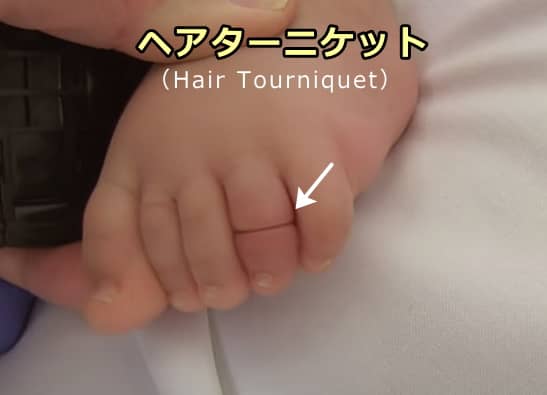 人間の赤ちゃんの指先で発症したヘアターニケット症候群