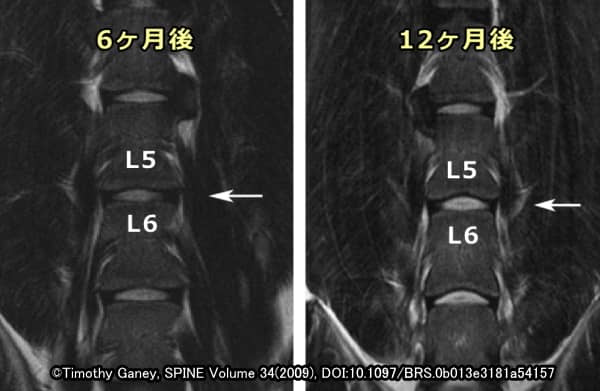 間葉系幹細胞の直接注入により高さを回復した犬の椎間板（L5-L6間）
