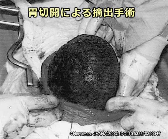 胃切開による接着剤の除去手術