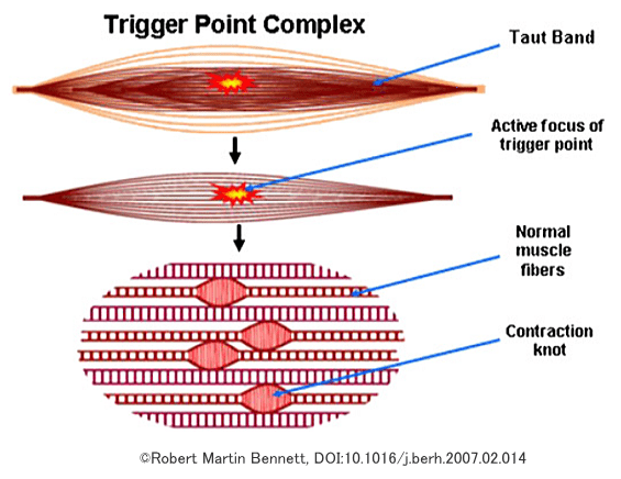 トリガーポイントの発生機序・模式図