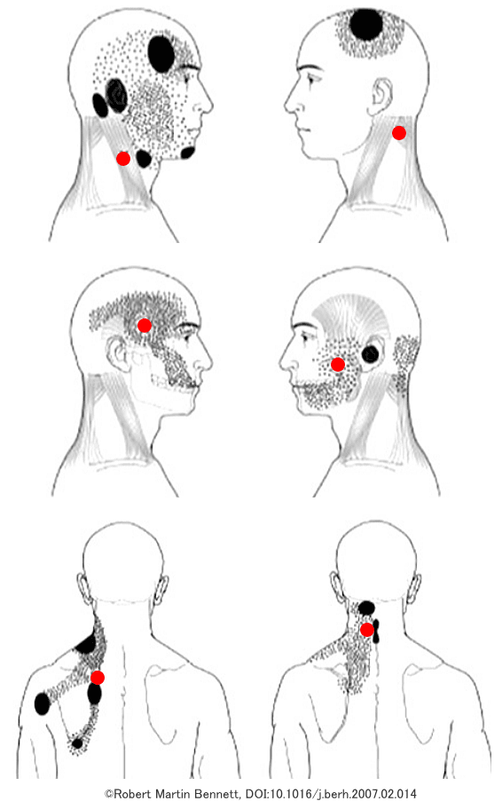 人体におけるトリガーポイントと発痛領域