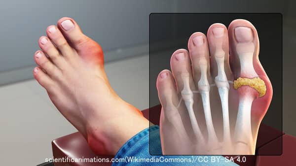 人間の痛風患者に多発する足親指のポダグラ