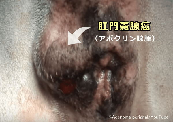 肛門嚢に含まれるアポクリン腺が悪性化して肛門嚢腺癌(anal sac adenocarcinoma)を形成する